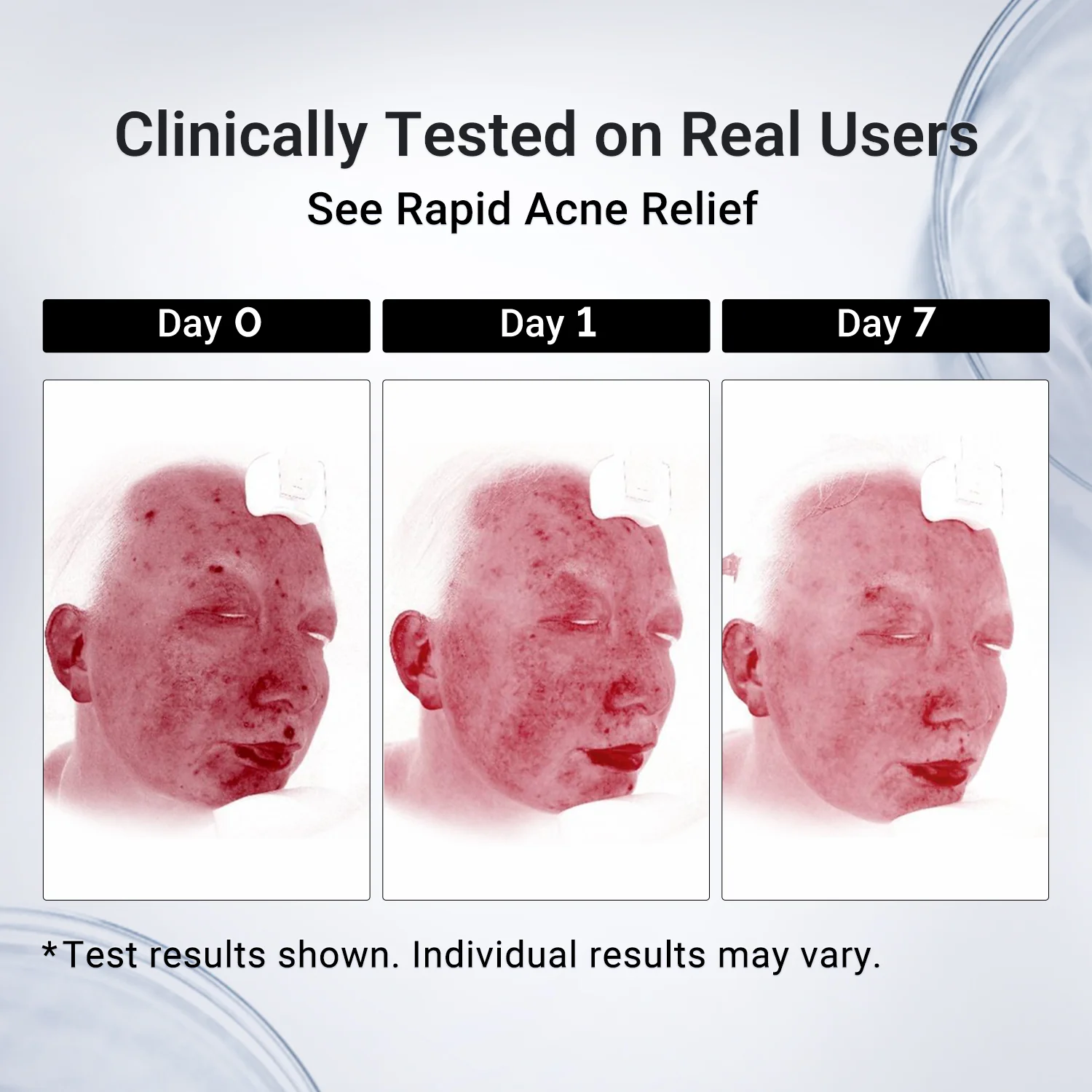 Acne Drying Lotion Plus — 2 Pack (20 mL × 2) - Image 7